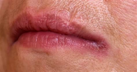 queilitis angular|Angular cheilitis: Causes, symptoms, treatment and。